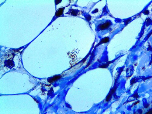 IHC of Myobacterium Tuberculosis on an FFPE Infected Lung Tissue